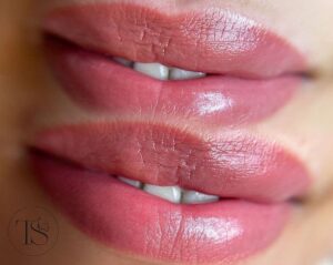 Dark-Lip-Neutralization