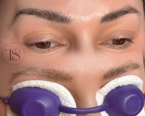 Laser-Removal-Of-Old-Permanent-Makeup